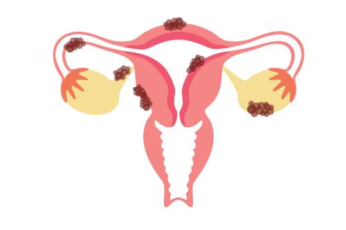 Miomectomía histeroscópica