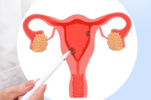 Tratamiento de poliposis endometrial