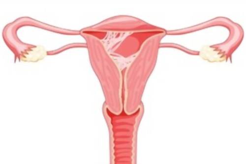 Tratamiento de síndrome de Asherman (sinequias uterinas)