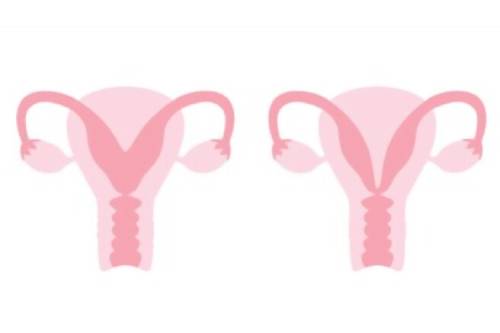 Tratamiento de útero bicorne, didelfo, arcuato y septado por histeroscopia